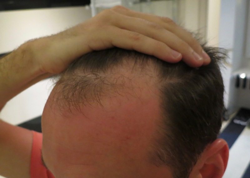 Haartransplantation Erfahrung mit Elithairtransplant