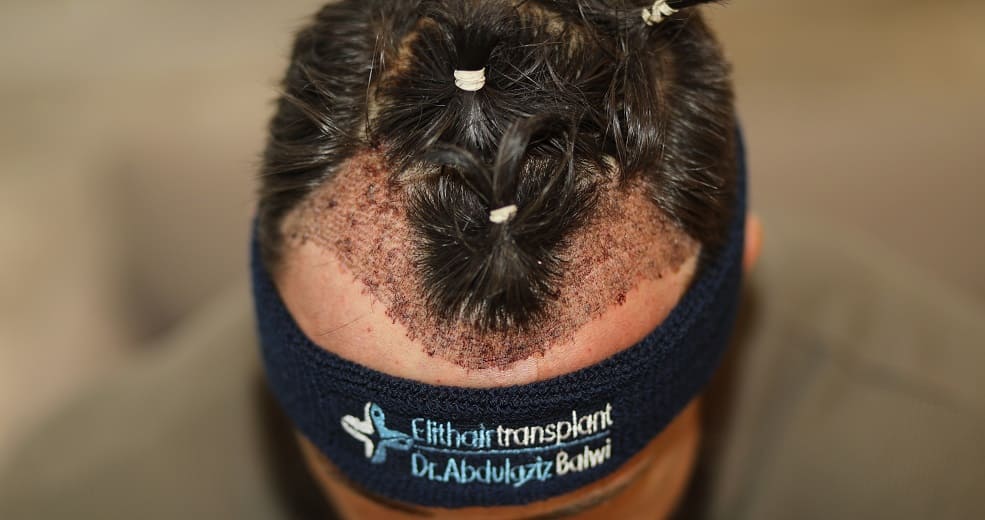 Patient zeigt sein Ergebnis nach der Haartransplantation ohne Rasur