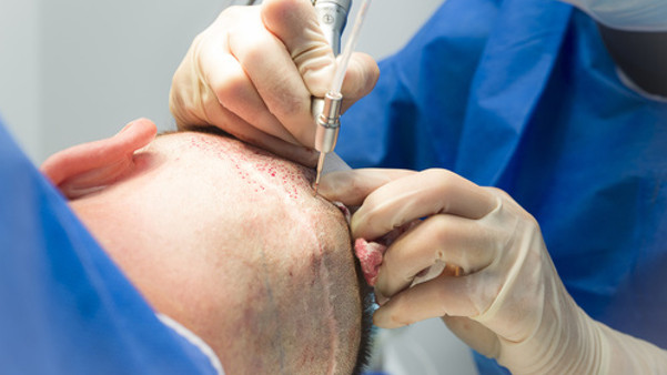 Haarausfall Behandlung narben