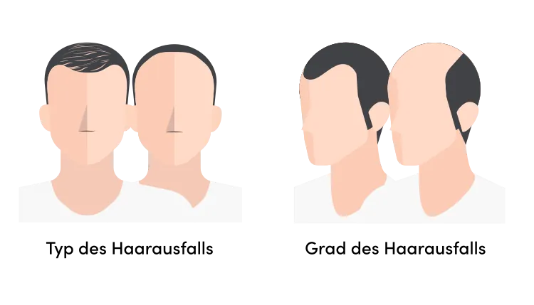 Eine Infografik zum Typ und Grad des Haarausfalls mit der Elit Skala