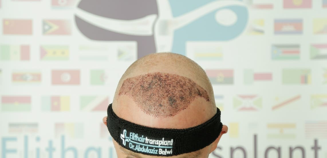 Haartransplantation nach der Trennung