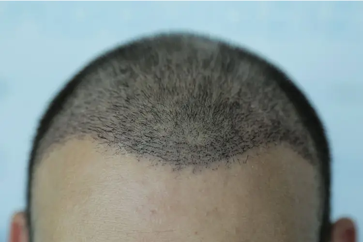 Der obere Teil des Kopfes eines Patienten, der eine Haartransplantation durchgeführt hat