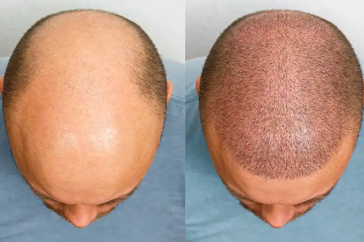 Ein Vorher-Nachher Bild eines Patienten nach einer Haartransplantation