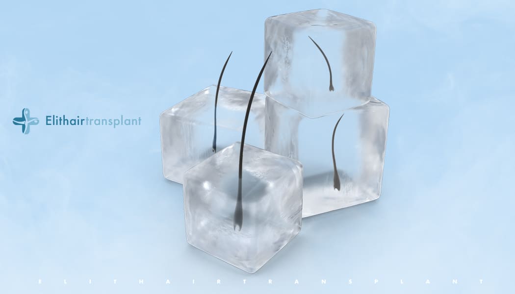 Haartransplantation mit Ice-Grafts
