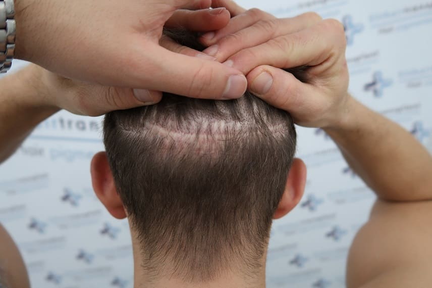 Haartransplantation bei Narben