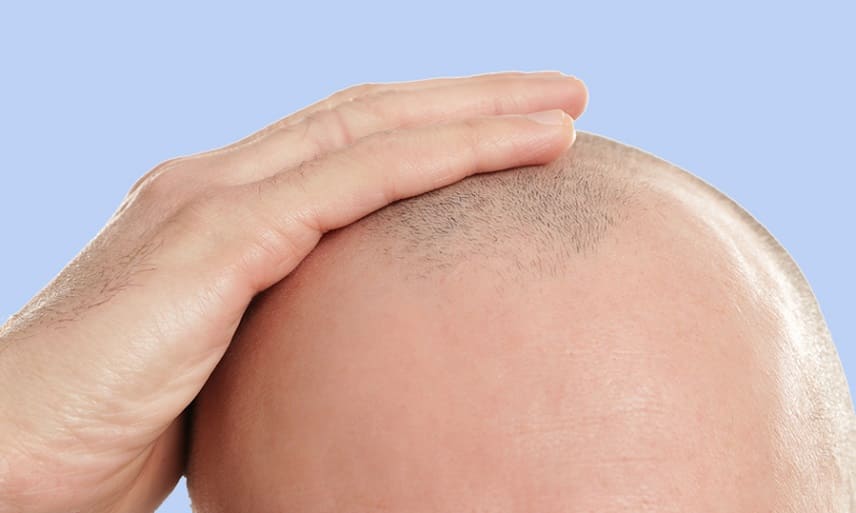 Haarausfall Strahlentherapie