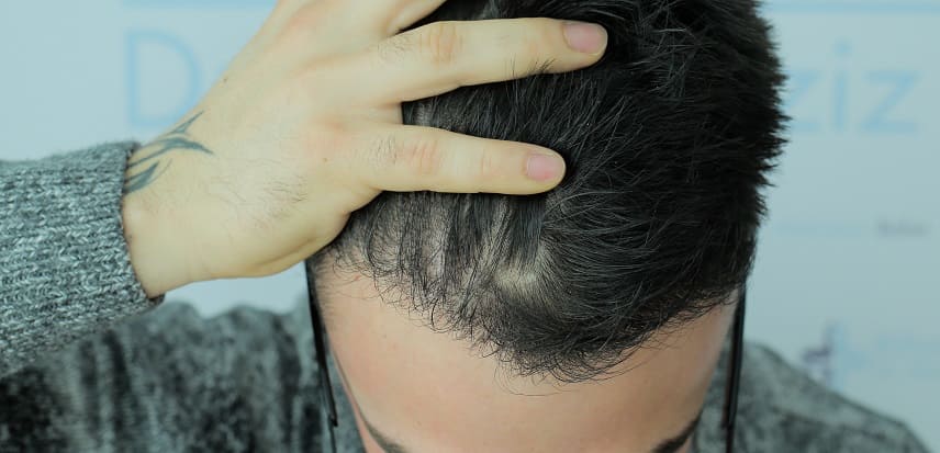 Juckende Kopf nach der Eigenhaartransplantation