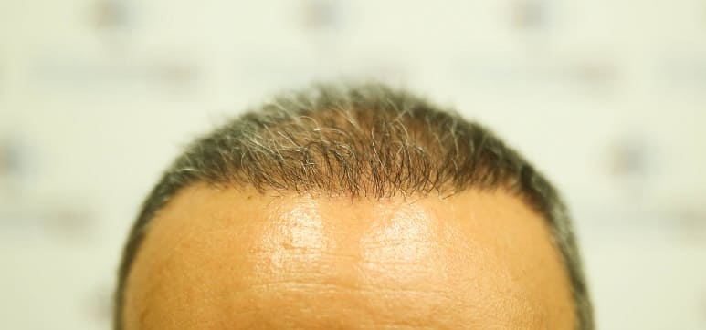 Juckende Kopf nach Haartransplantation kann auftreten