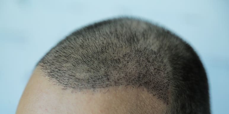 Juckende Kopf - Kopfhaut nach Haartransplantation