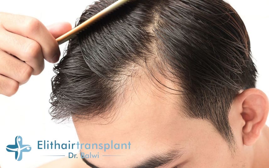 Haarausfall am Haaransatz - Geheimratscken beim Mann