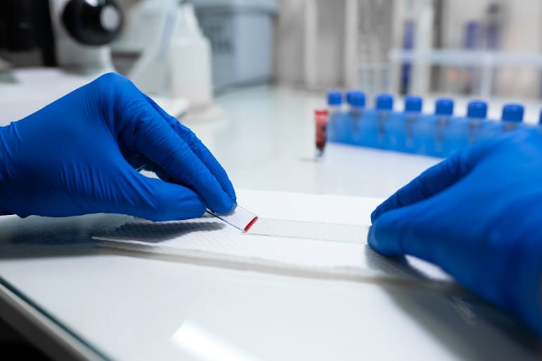 Ein großes Blutbild hilft bei der Ursachenforschung Arzt bereitet Blutprobe zur Untersuchung unter dem Mikroskop vor