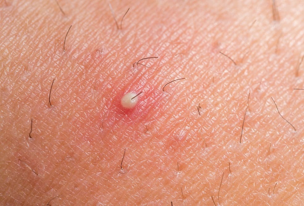 Zu den Symptomen einer Haarwurzelentzündung gehören auch Eiterblasen Nahaufnahme einer Haarwurzelentzündung mit Eiterbläschen