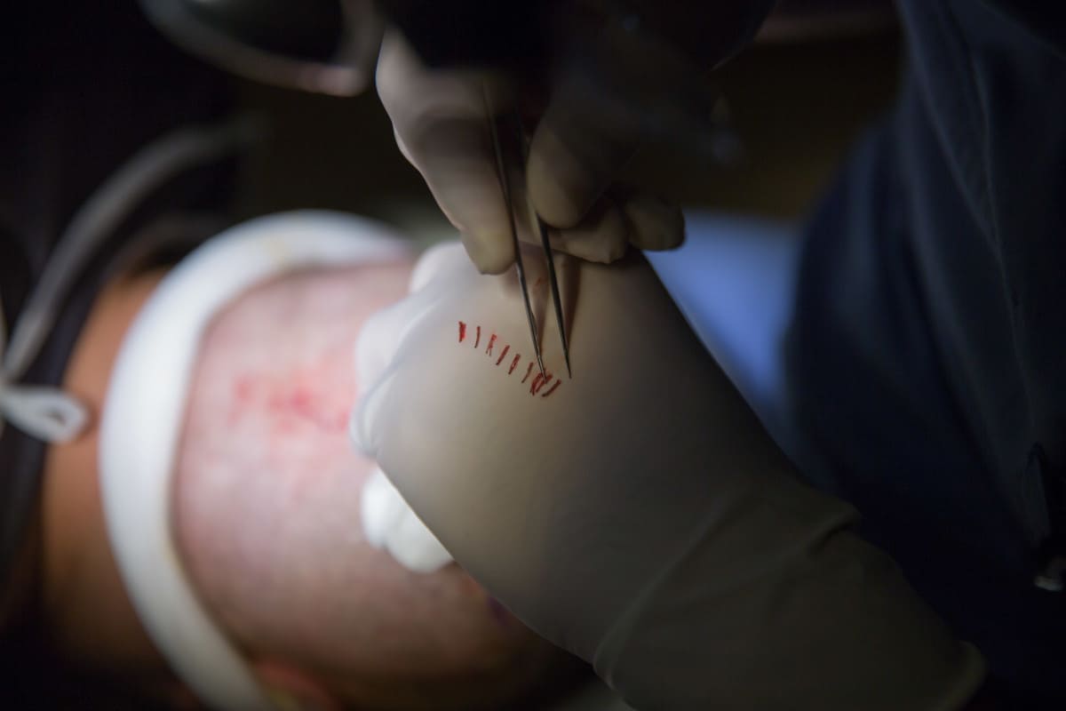 Haartransplantation Schwellungen