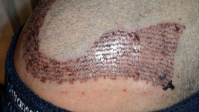 Nahaufnahme der Krustenbildung nach einer Haartransplantation.