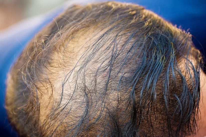 Nahaufnahme eines Männerkopfs mit lichtem Haar.