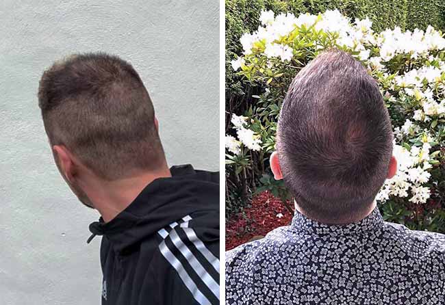 Haartransplantation Vorher Nachher Spenderbereich bei Patient Andre