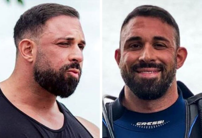 Nachher Saphir Haartransplantation mit 2700 Grafts bei Patient Kevin Wolter