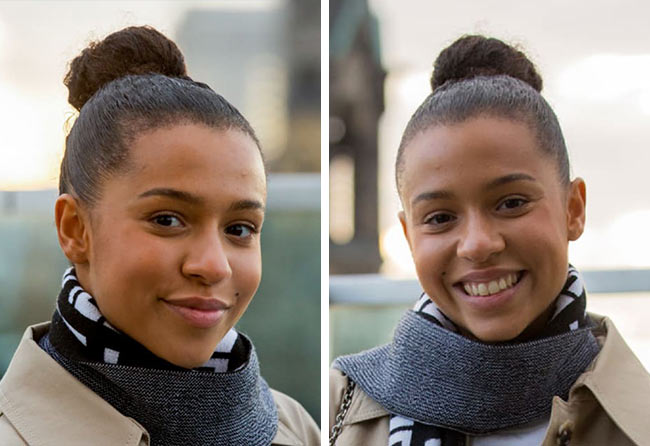 Nachher saphir haartransplantation 2700 grafts Melissa Z