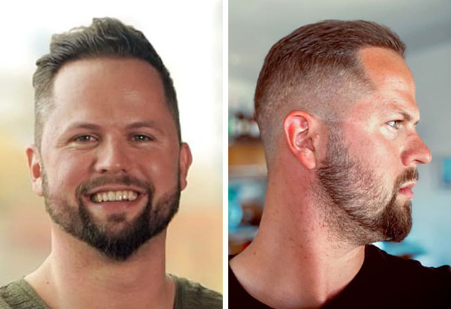 Nachher Saphir Haartransplantation mit 2800 Grafts bei Patient Nico Gumlich