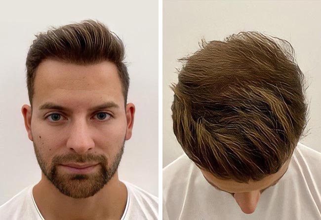 Nachher Saphir Haartransplantation mit 4200 Grafts bei Patient Marcel Oliva