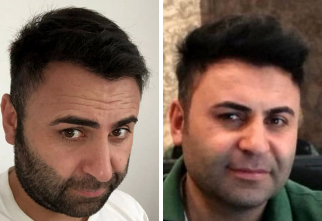 Nachher Saphir Haartransplantation mit 4200 Grafts bei Patient Murat Kizilkaya
