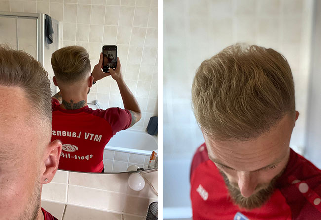 Nachher Saphir Haartransplantation Tonsur mit 4700 Grafts bei Patient Frederik Gigers