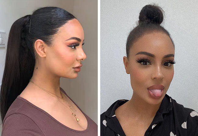 Nachher SDHI Haartransplantation mit 3200 Grafts bei Patientin Jahy C