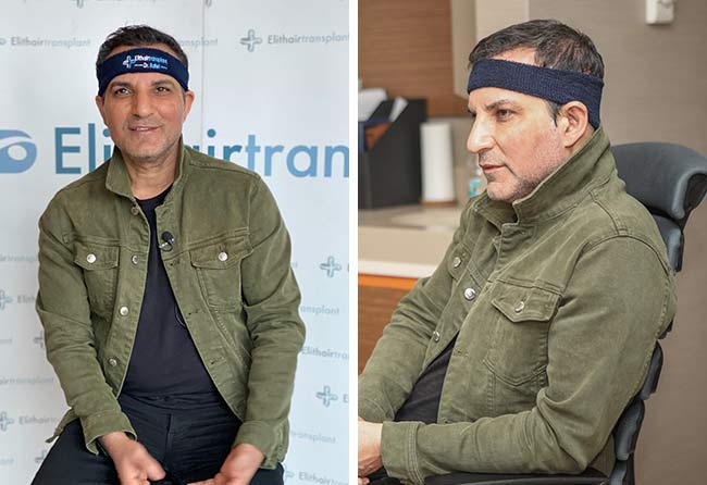 Vorher DHI Haartransplantation mit 2600 Grafts bei Patient Rafet El Roman