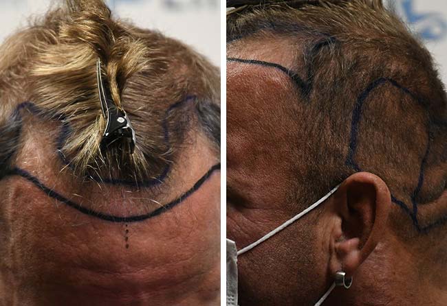 Vorher DHI Haartransplantation mit 2900 Grafts bei Patient Hollywood Matze