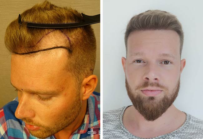 Vorher nachher Saphir Haartransplantation mit 2800 Grafts bei Patient Alexander Kitzel