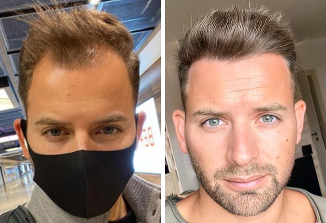 Vorher nachher Saphir Haartransplantation mit 4200 Grafts bei Patient Marcel Oliva