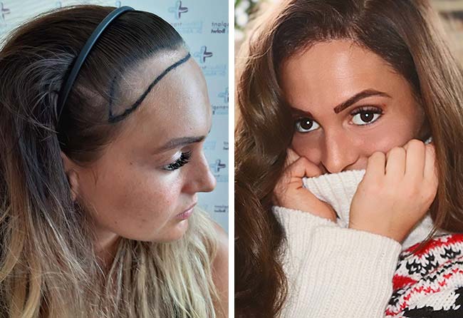 Vorher nachher Saphir Haartransplantation mit 2200 Grafts bei Patientin Karin Baumann