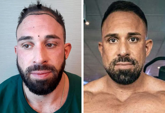 Vorher nachher Saphir Haartransplantation mit 2700 Grafts bei Patient Kevin Wolter