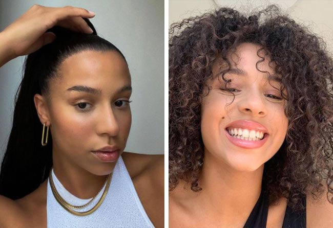 Vorher nachher Saphir Haartransplantation mit 2700 Grafts bei Patientin Melissa Zerhau-nach-4 Monaten