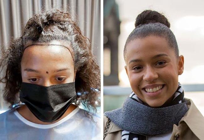 Vorher nachher Saphir Haartransplantation mit 2700 Grafts bei Patientin Melissa Zerhau