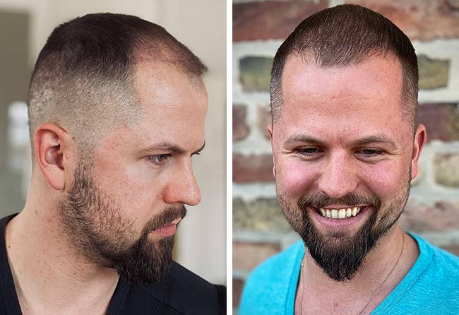 Vorher nachher Saphir Haartransplantation mit 2800 Grafts bei Patient Nico Gumlich nach 3 Monaten