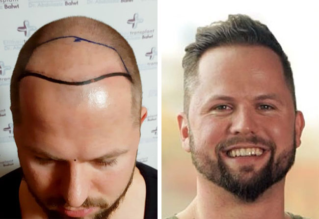 Vorher nachher Saphir Haartransplantation mit 2800 Grafts bei Patient Nico Gumlich