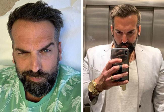 Vorher Nachher Saphir Haartransplantation mit 3400 Grafts Bei Patient Jürgen T nach 10 monaten