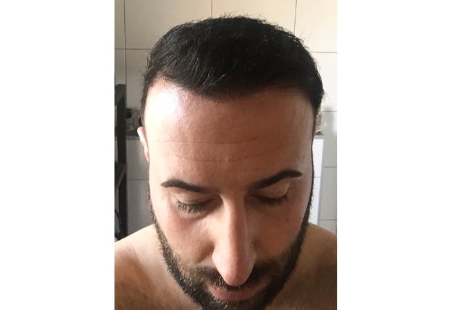 Oberkopf Heilung nach 3 Monaten &ndash; Artin A., 3.500 Grafts