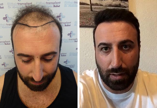 Vorher nachher Saphir Haartransplantation mit 3500 Grafts bei Patient Artin Asrian