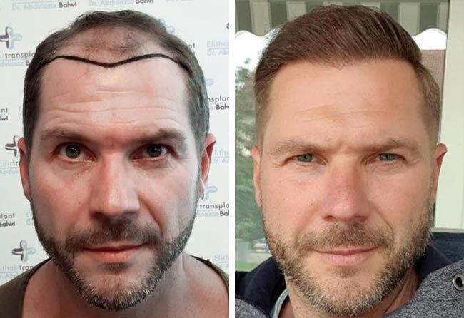 Vorher nachher Saphir Haartransplantation mit 4100 Grafts bei Patient Markus