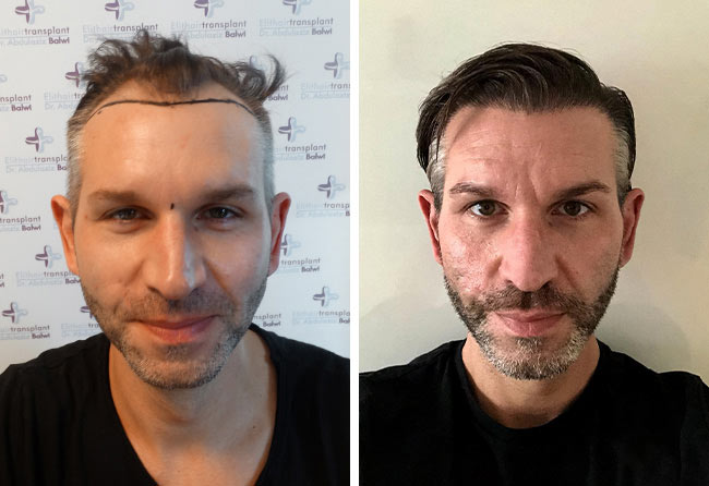 Vorher nachher Saphir Haartransplantation mit 4250 Grafts bei Patient Thomas Schreier