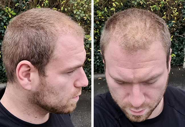 Vorher nachher Saphir Haartransplantation mit 4500 Grafts bei Patient Kewin Lenzing nach 3 Monaten