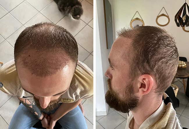 Vorher nachher Saphir Haartransplantation mit 4700 Grafts bei Patient Frederik Gigers nach 2 Monaten