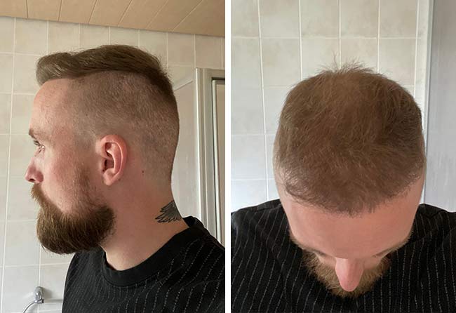 Vorher Nachher Saphir Haartransplantation mit 4700 Grafts bei Patient Frederik Gigers nach 6 Monaten