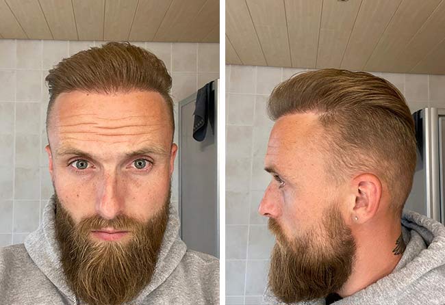 Vorher nachher Saphir Haartransplantation mit 4700 Grafts bei Patient Frederik Gigers nach 8 Monaten