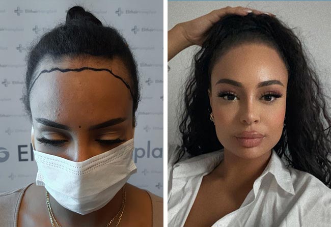 Vorher nachher SDHI Haartransplantation mit 3200 Grafts bei Patientin Jahy C