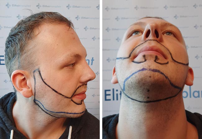 Vorher Saphir Barttransplantation mit 3250 Grafts bei Patient Sascha Lockemann