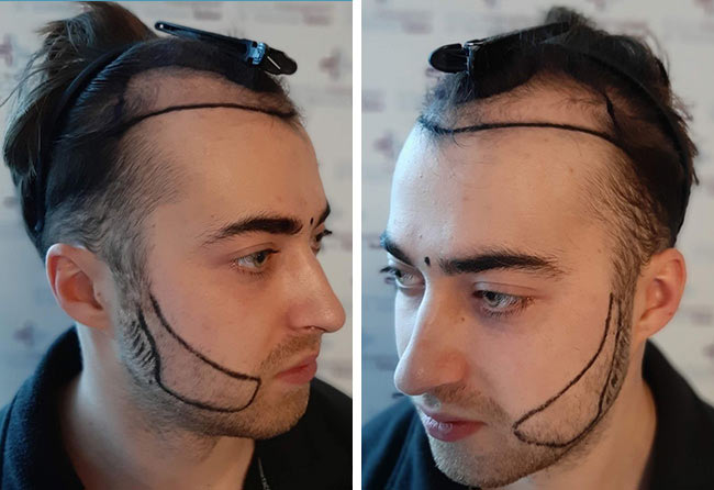 Vorher Saphir Barttransplantation mit 4250 Grafts bei Patient Andre Ulbrich