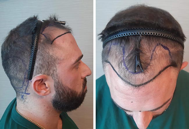 Vorher Saphir Haartransplantation mit 2700 Grafts bei Patient Kevin Wolter